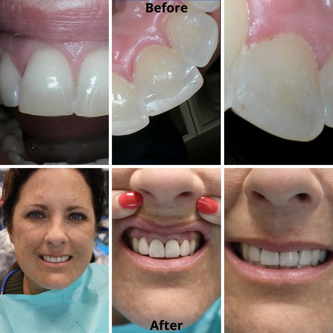 Dental Veneers