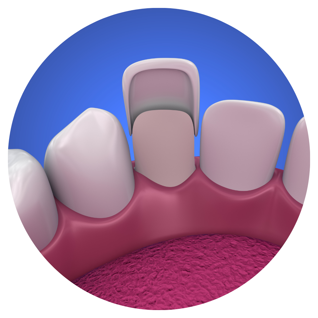 Dental Veneers