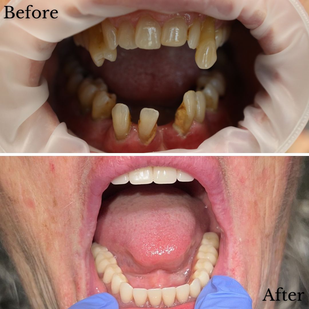 Before & After Dental Implant Treatment At Timberline