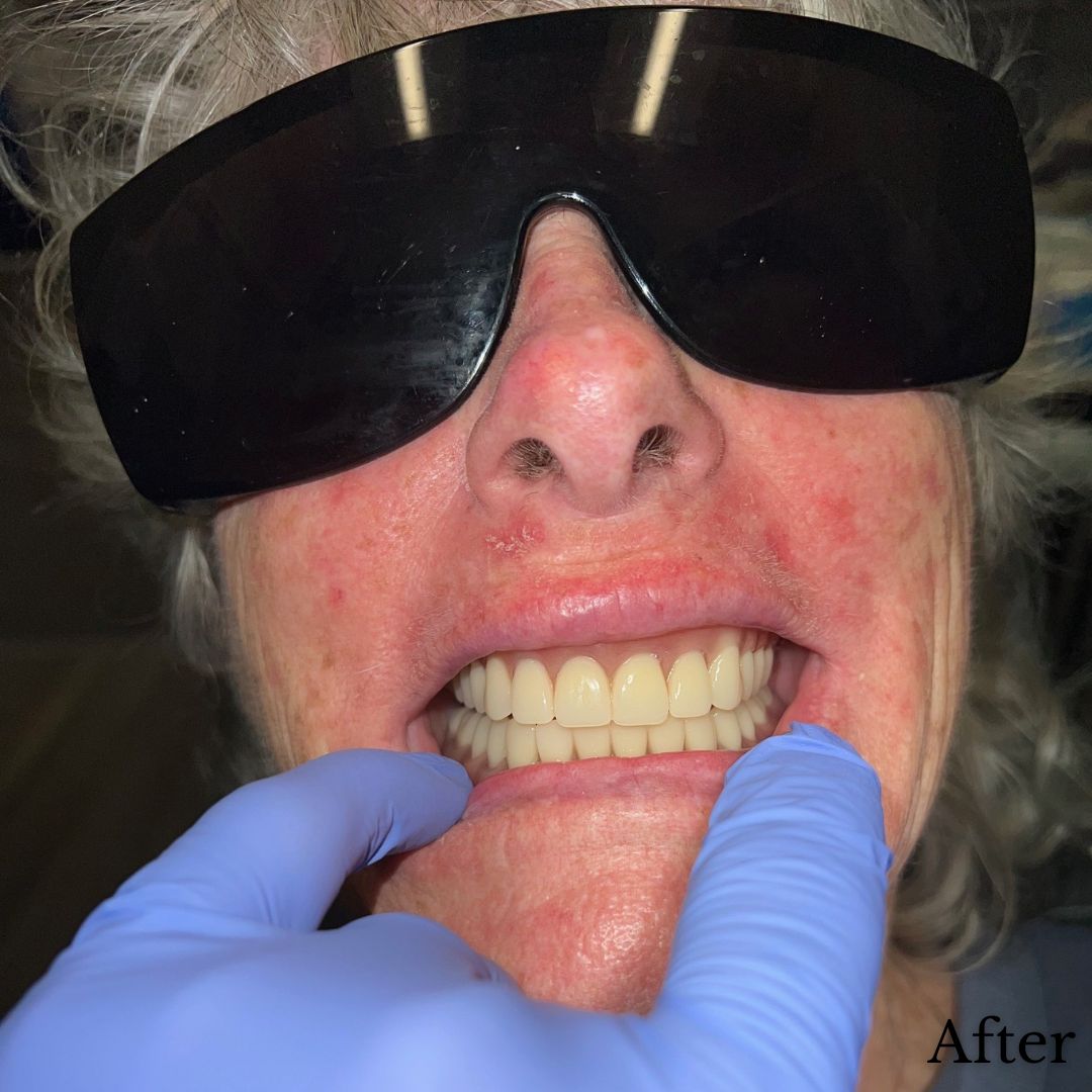 Before & After Dental Implant Treatment At Timberline