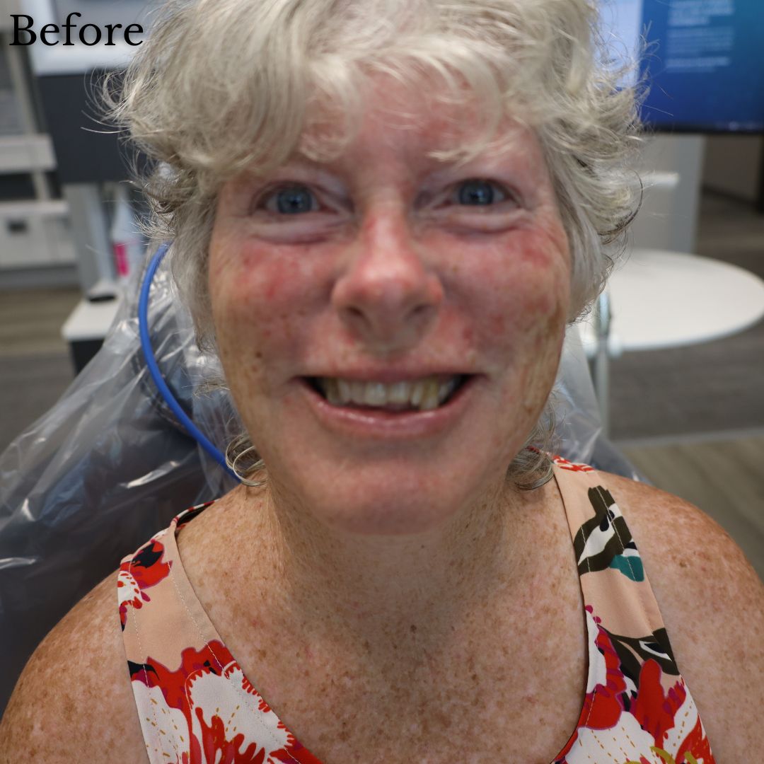 Before & After Dental Implant Treatment At Timberline