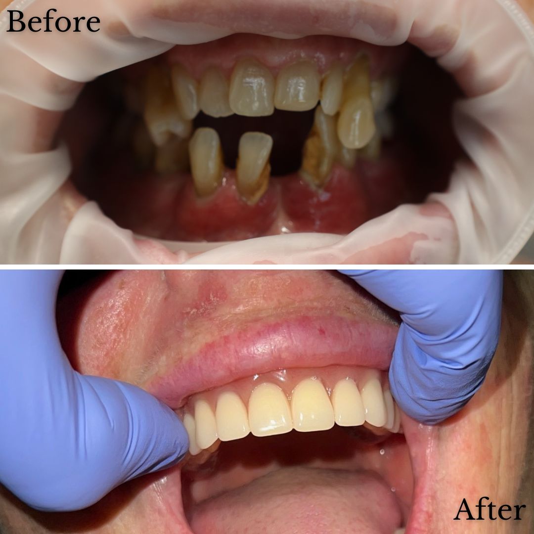 Before & After Dental Implant Treatment At Timberline